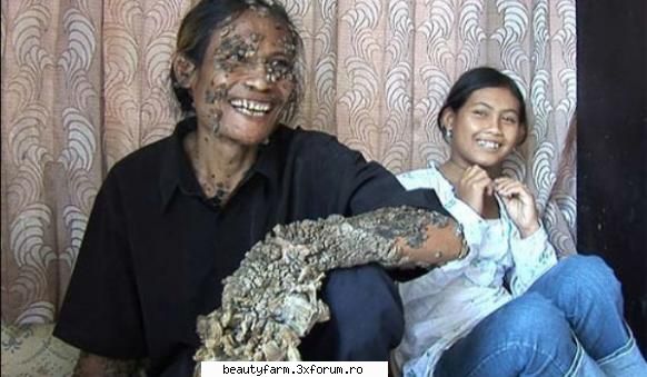omul copac socheaza intreaga lume dede koswara satean varsta ani din indonezia si-a dobandit