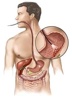 Cancerul Gastric - CANCERUL GASTRIC Una dintre cele mai frecvente - SANATATE