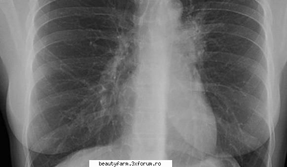 Tuberculoza...................... B. infectioasa - Tuberculoza loveste din nou In Africa si in - SANATATE